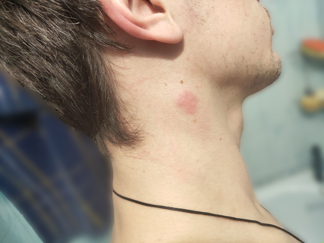 Воспаление лимфоузлов на шее у мужчин фото
