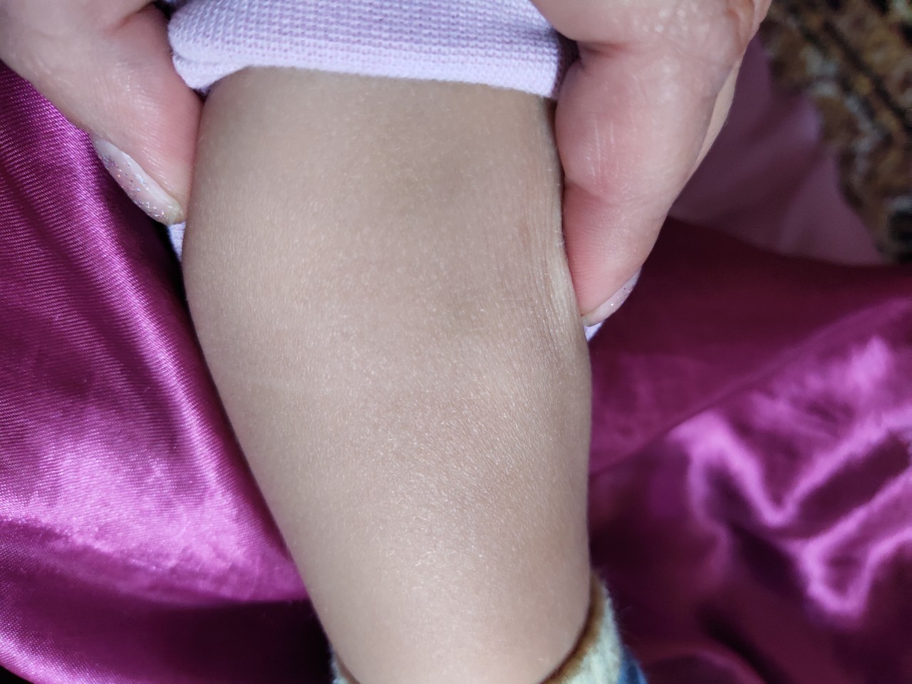 Белое пятно на ножке у ребенка