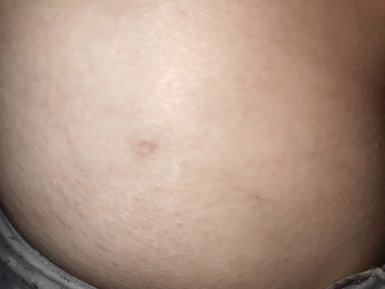 красное пятно на груди во время беременности фото 46