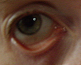 Симптомы повреждение роговицы глаза