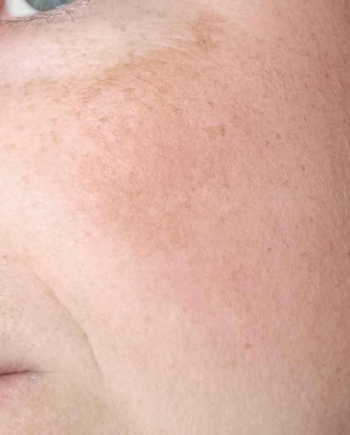Коричневые пятна на лице - Вопрос дерматологу - 03 Онлайн