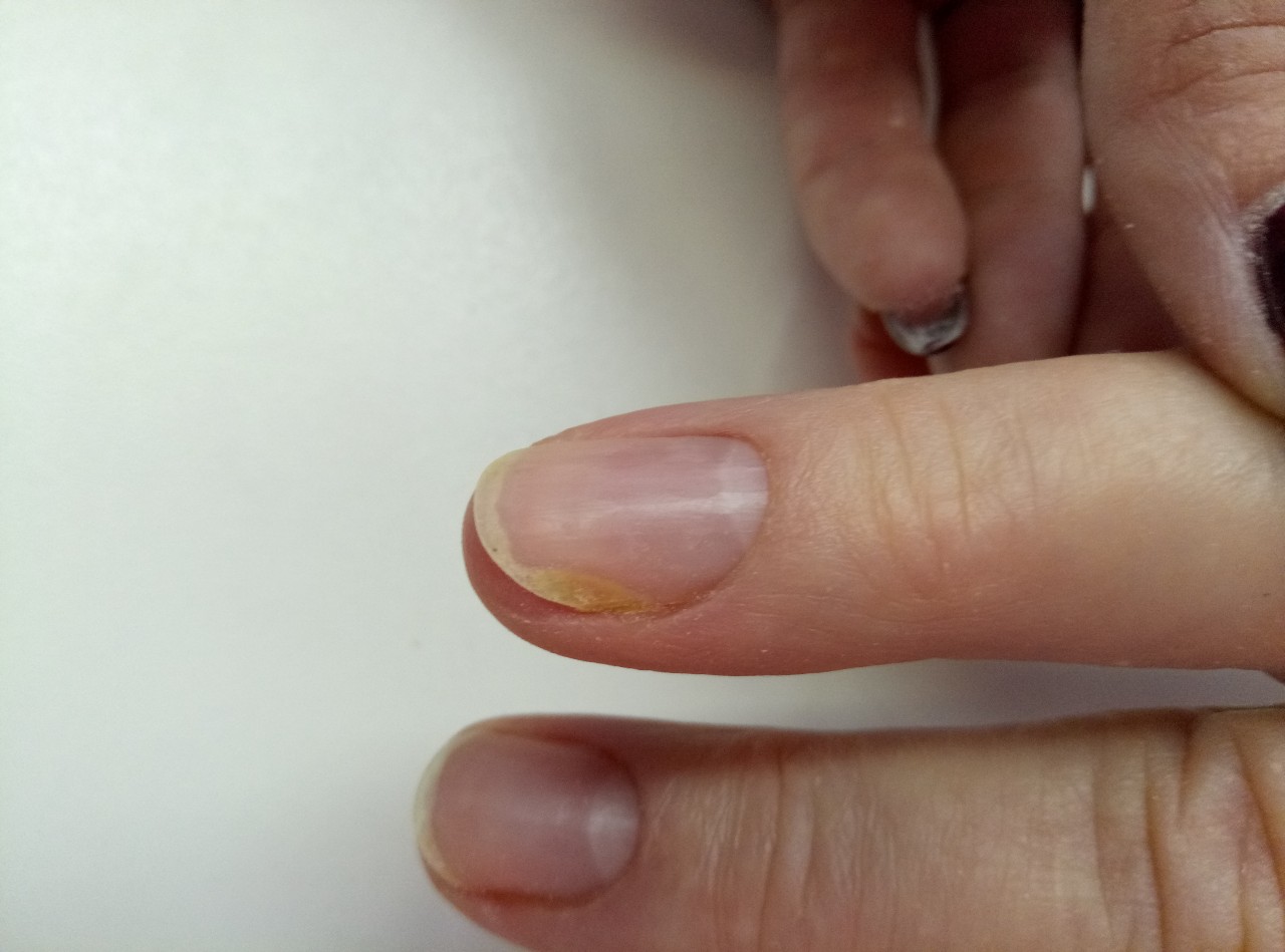 Ногти отслаиваются от ногтевого