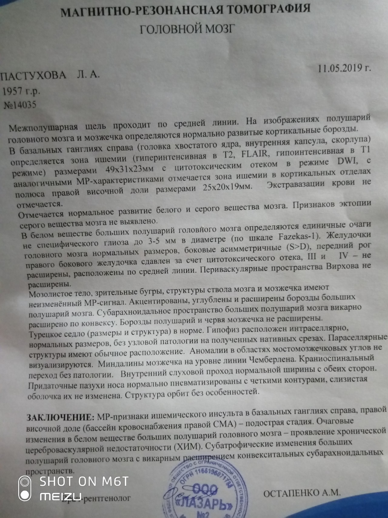 Глиоз головного мозга что это. Глиоз головного мозга. Субатрофические изменения головного мозга. Множественные очаги глиоза в белом веществе головного мозга. Правая СМА головного мозга расшифровка.