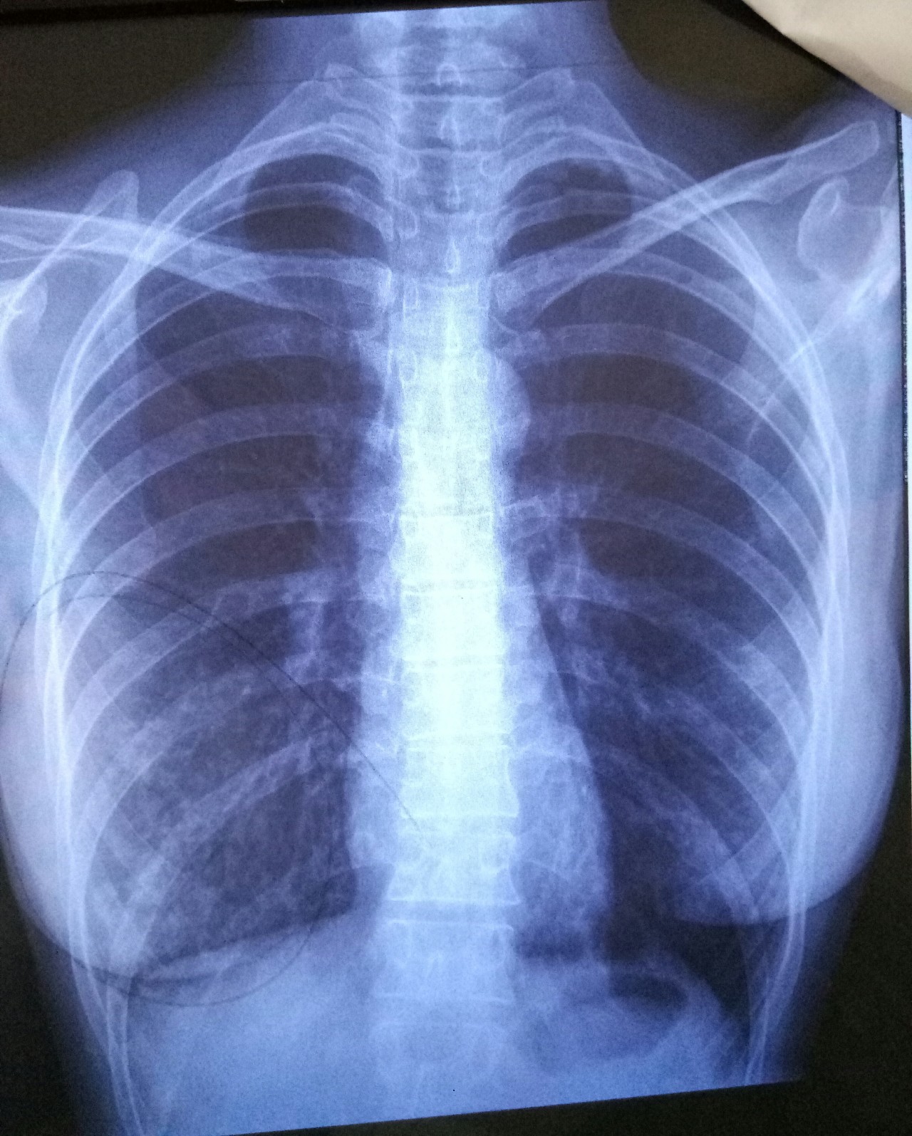снимок легких при туберкулезе фото