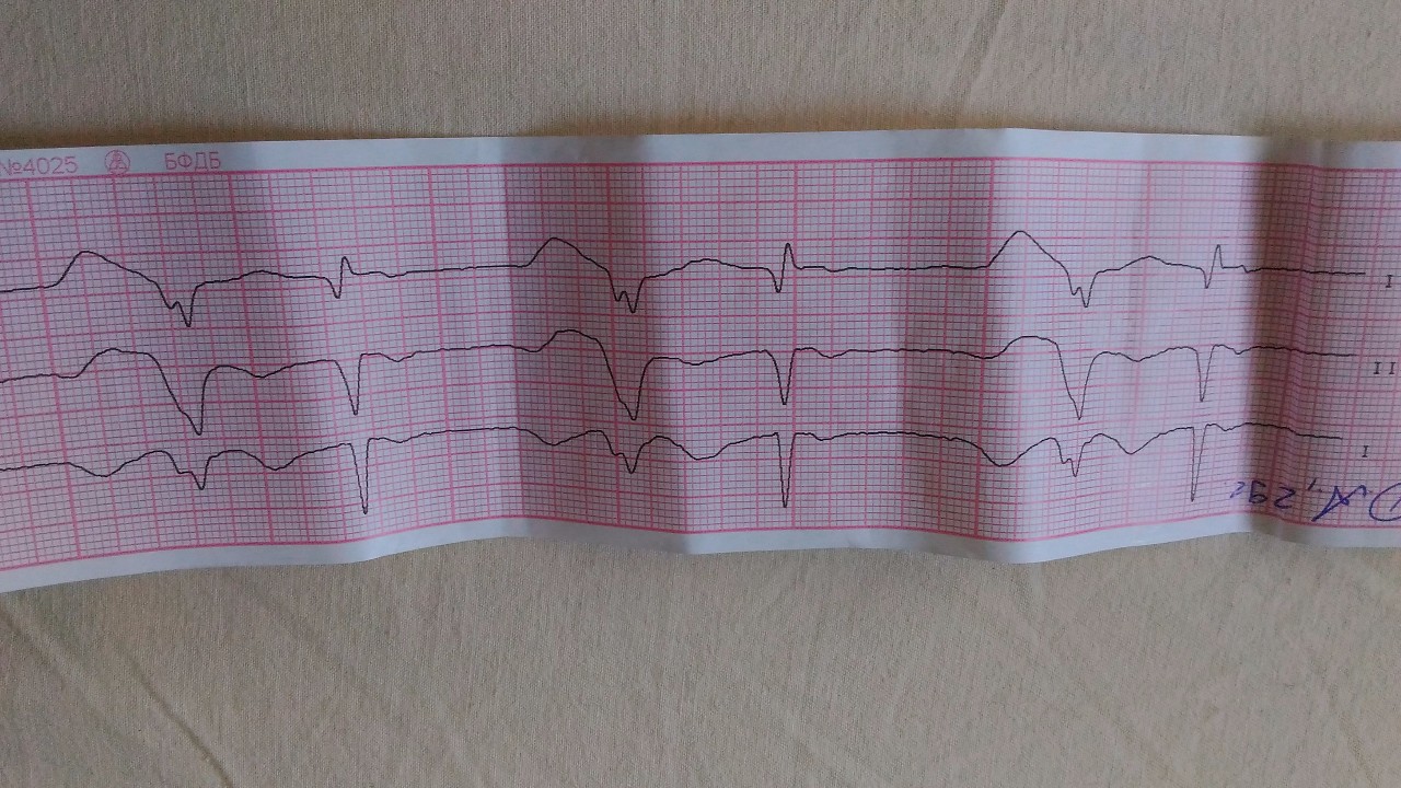 Желудочковая экстрасистолия на экг фото