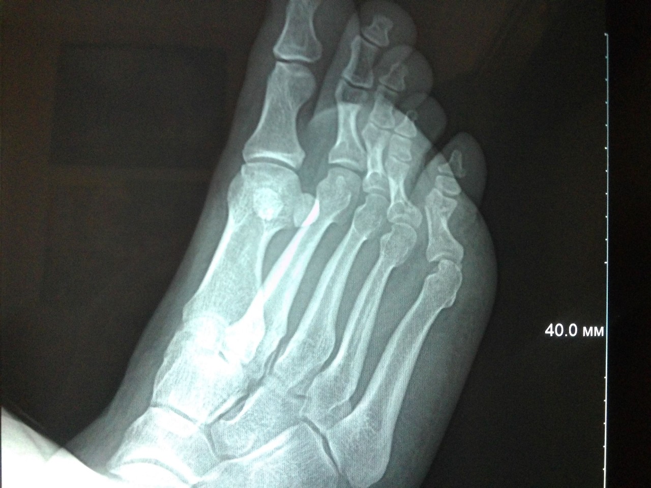 5 фаланга стопы. Перелом фаланги пальца стопы рентген.