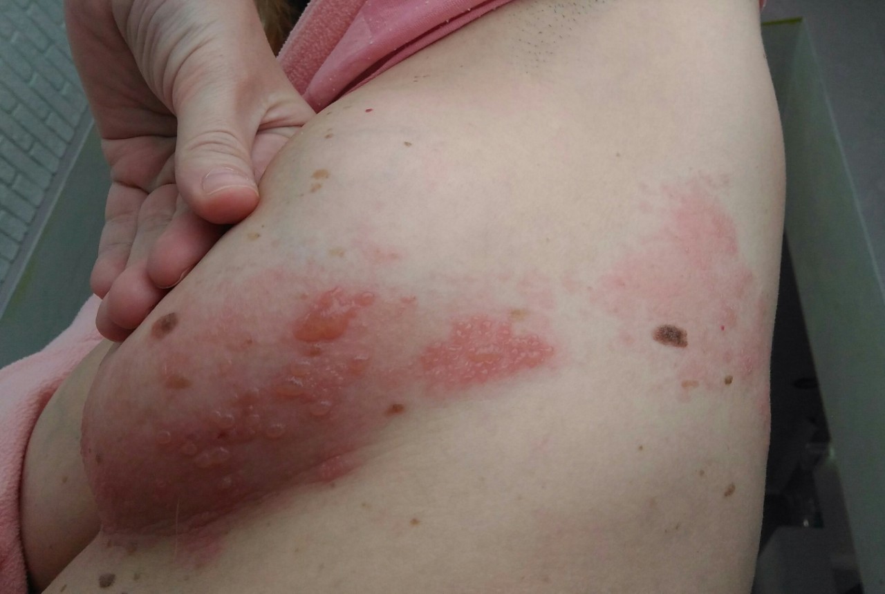 аллергия на грудях у кормящей мамы фото 6