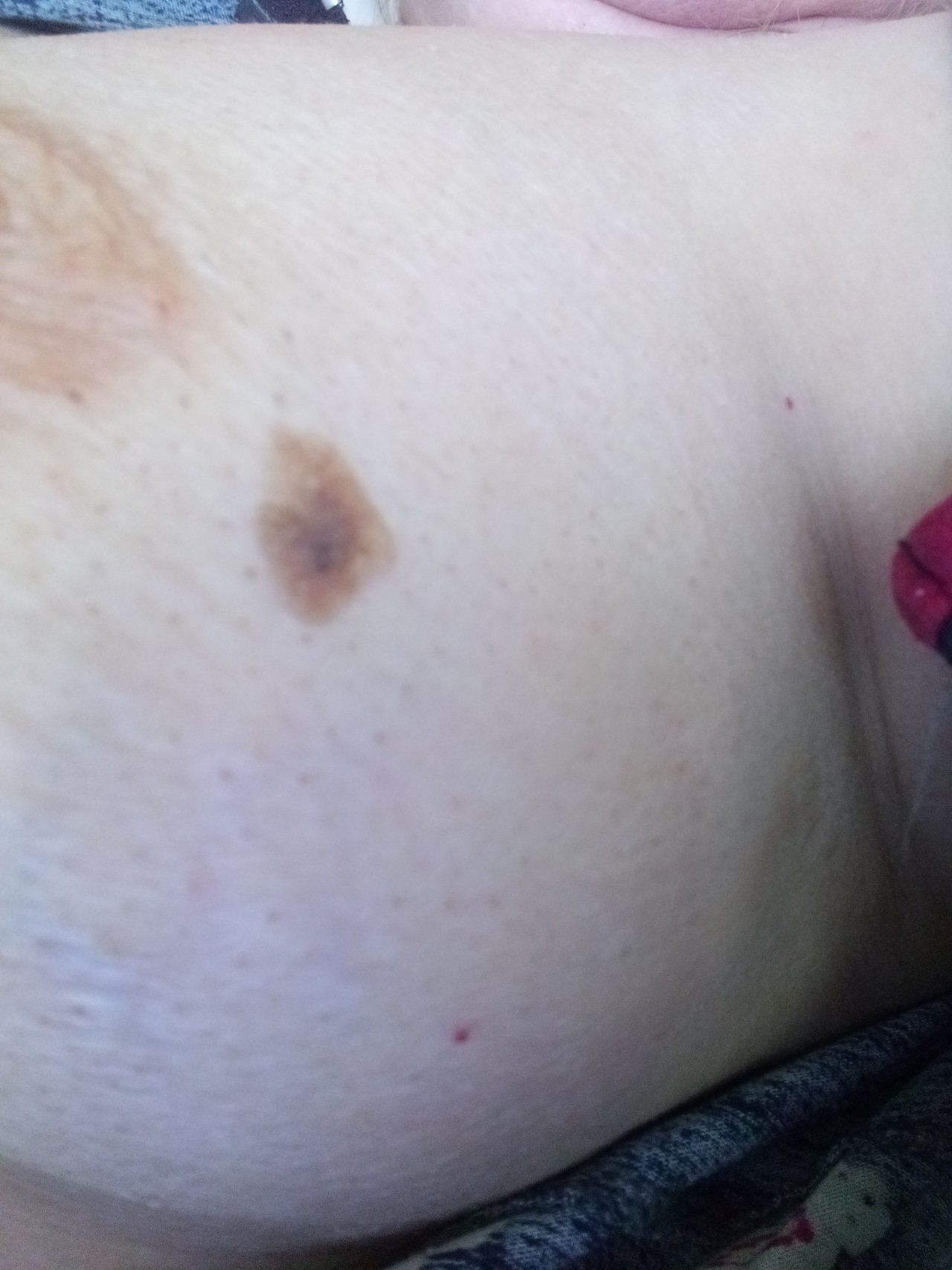 гнойные раны на груди у женщин фото 60