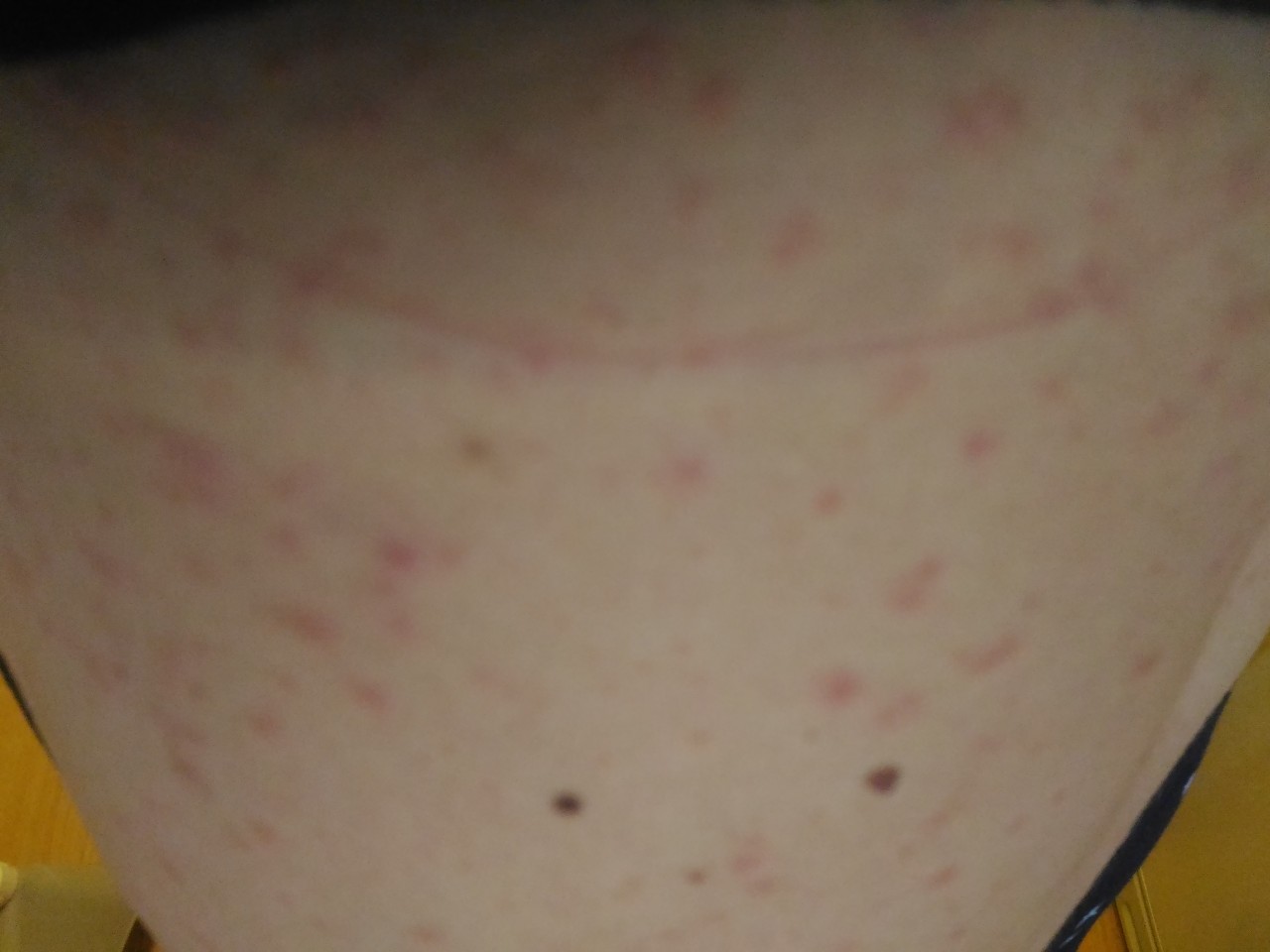 красные точки на груди у женщин фото 18