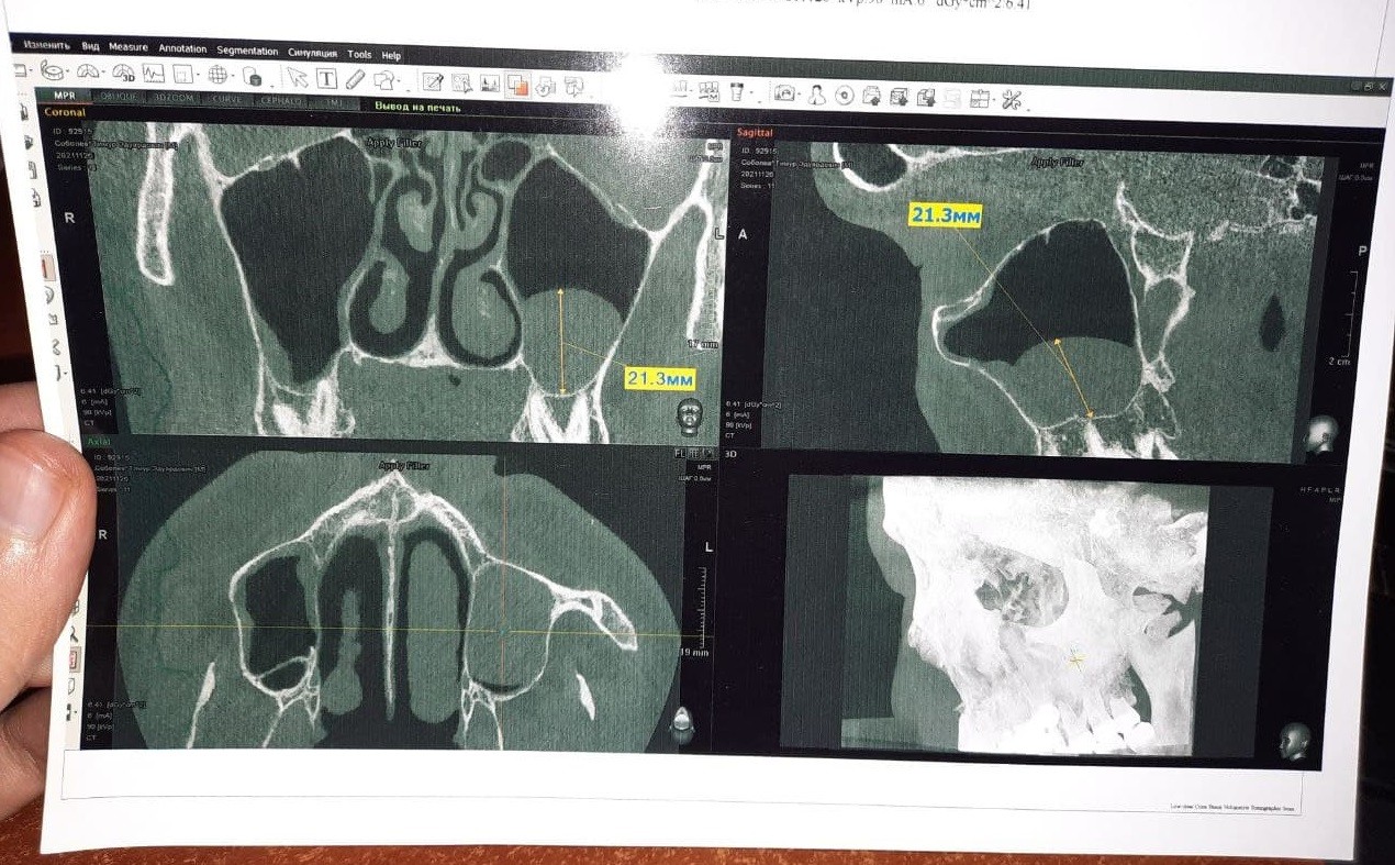Полип носа кт. Полип гайморовой пазухи на кт. Полип в носовой пазухе на кт.