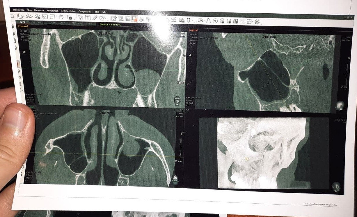 Сделать кт носа. Аплазия клиновидной пазухи кт. Киста гайморовой пазухи на кт.
