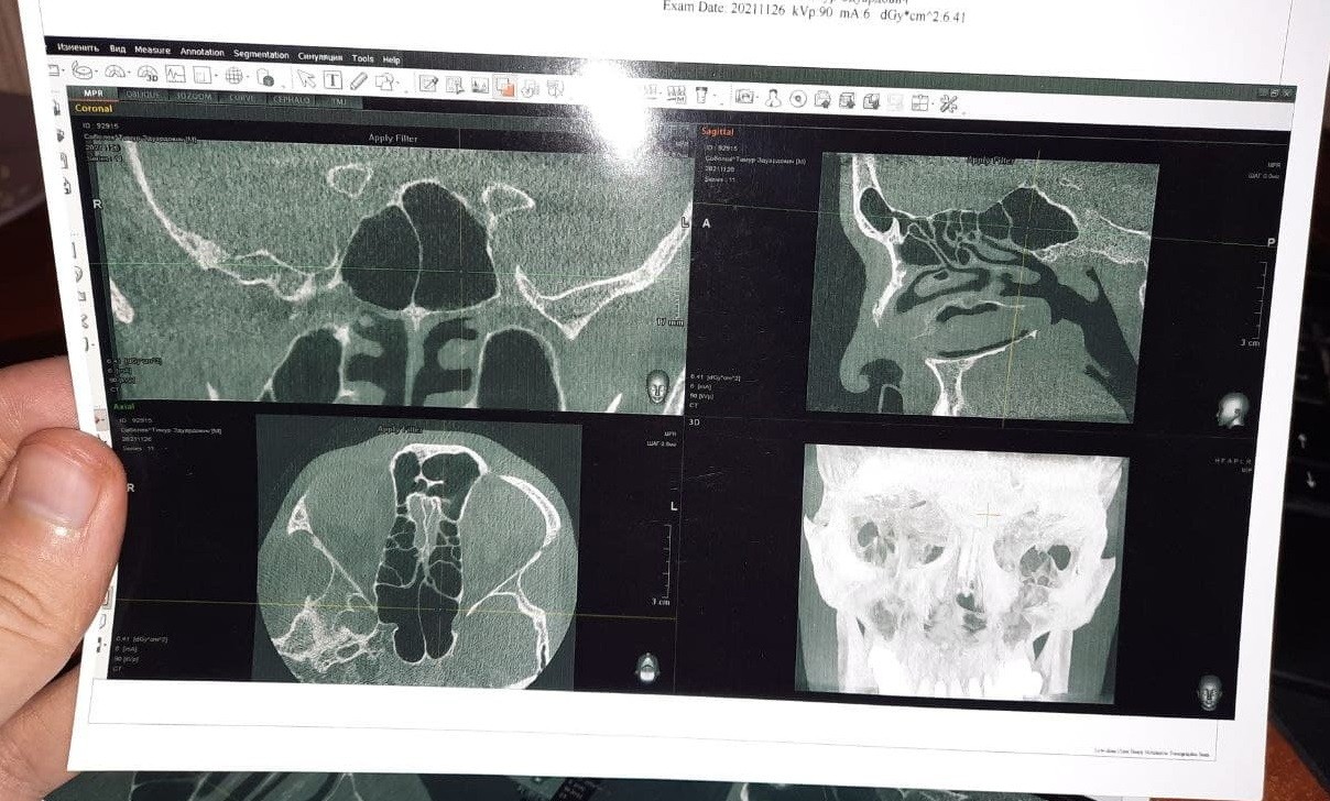 Кт в домодедово. Конусно-лучевая компьютерная томография пазух носа. Кт носа и околоносовых пазух. Кт пазух носа МЕДСИ.