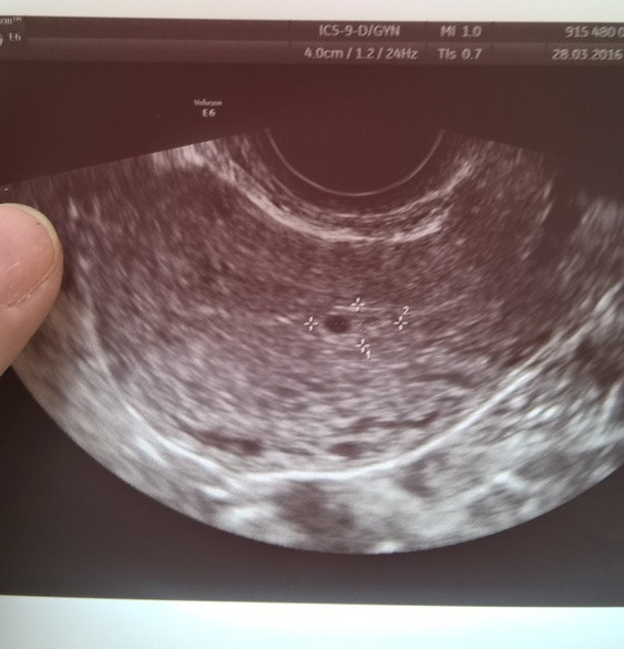 Фото узи беременности 3 неделя беременности