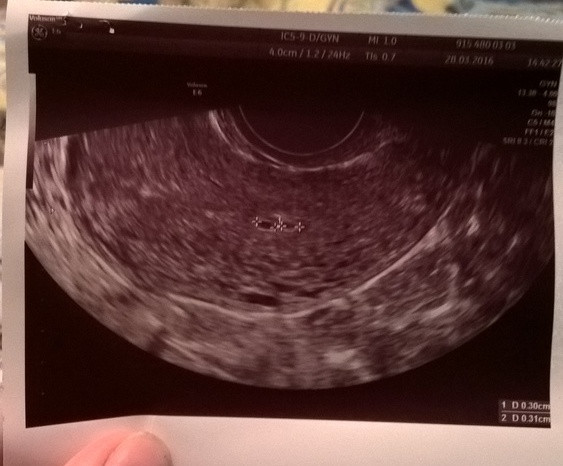 Через четыре недели. УЗИ 3 недельки беременности. УЗИ 2-3 недели беременности. Снимок УЗИ 2-3 недели беременности. УЗИ 1.5 недели беременности.