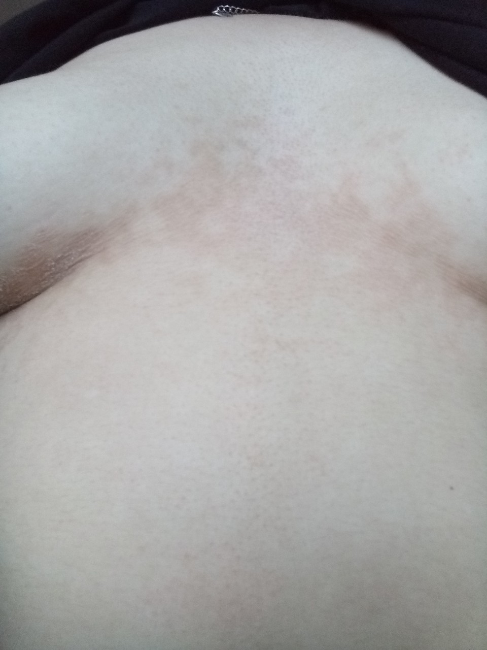 шелушится кожа на груди во время беременности фото 1