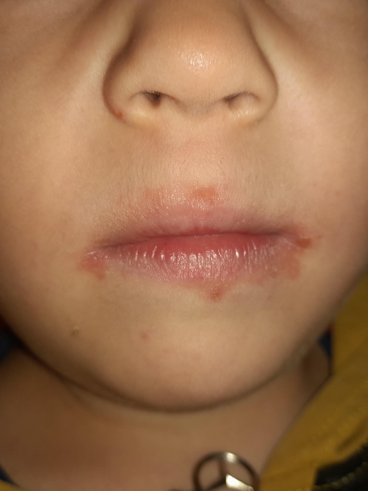 Кожный дерматит у ребенка фото