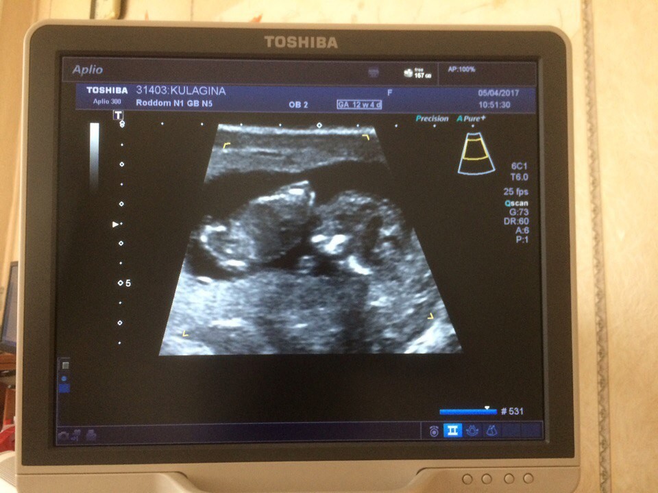 Фото узи 12 недель беременности двойня