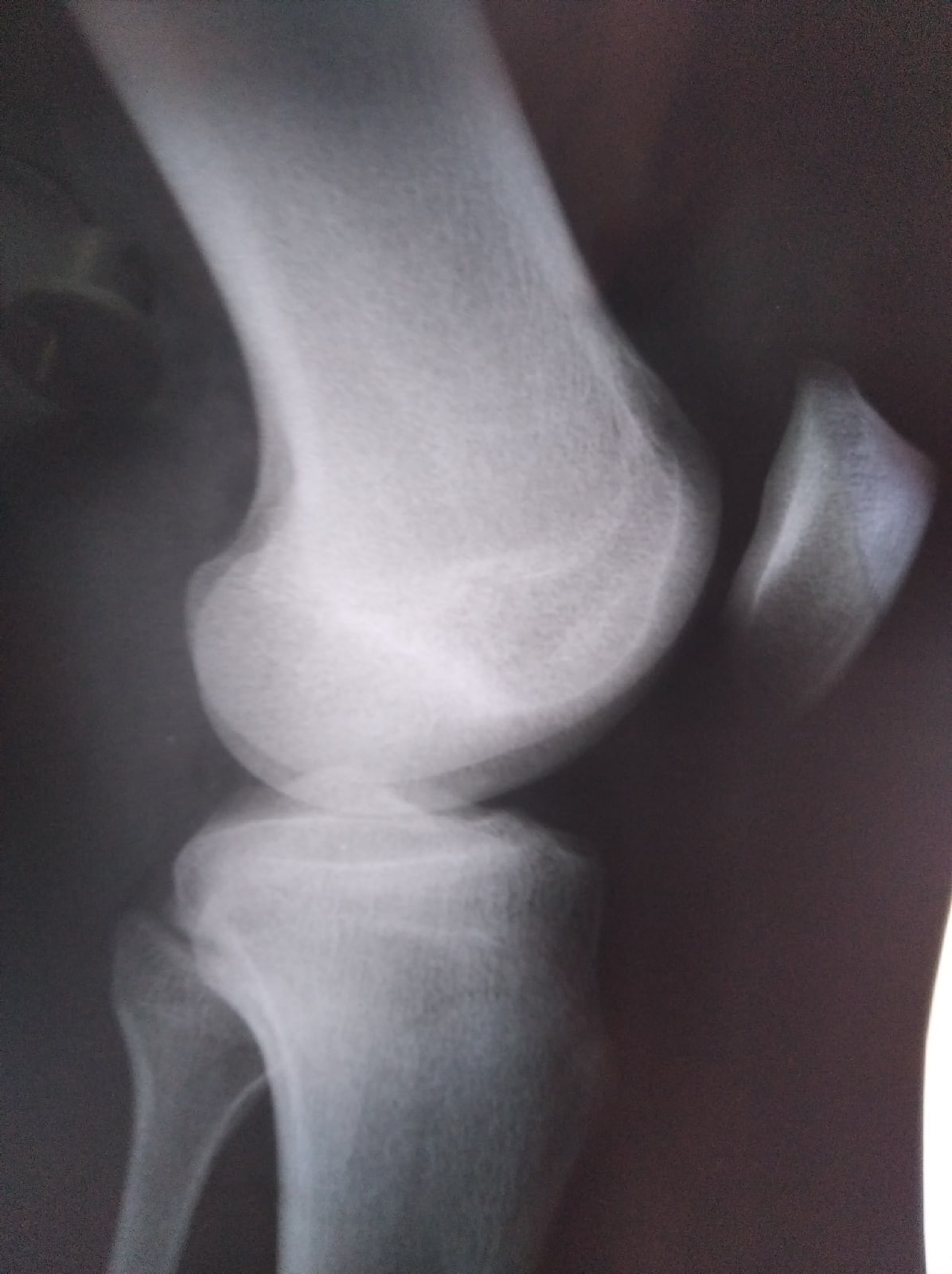 Зоны роста коленного сустава на рентгене