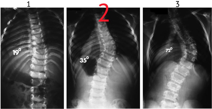 Сколиоз на рентгене фото