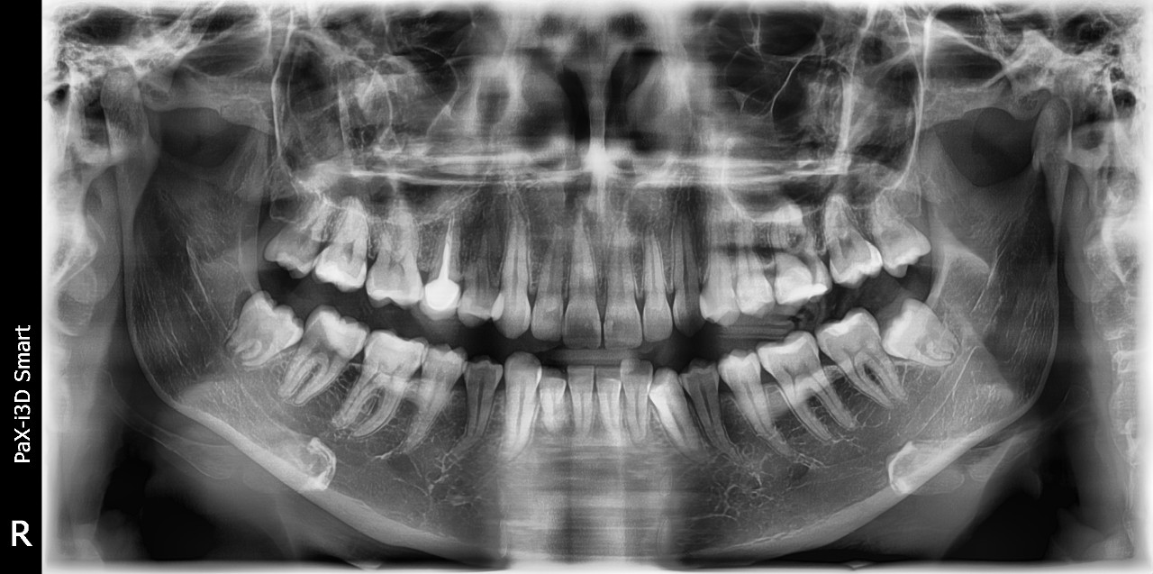 Снимок зуба мудрости