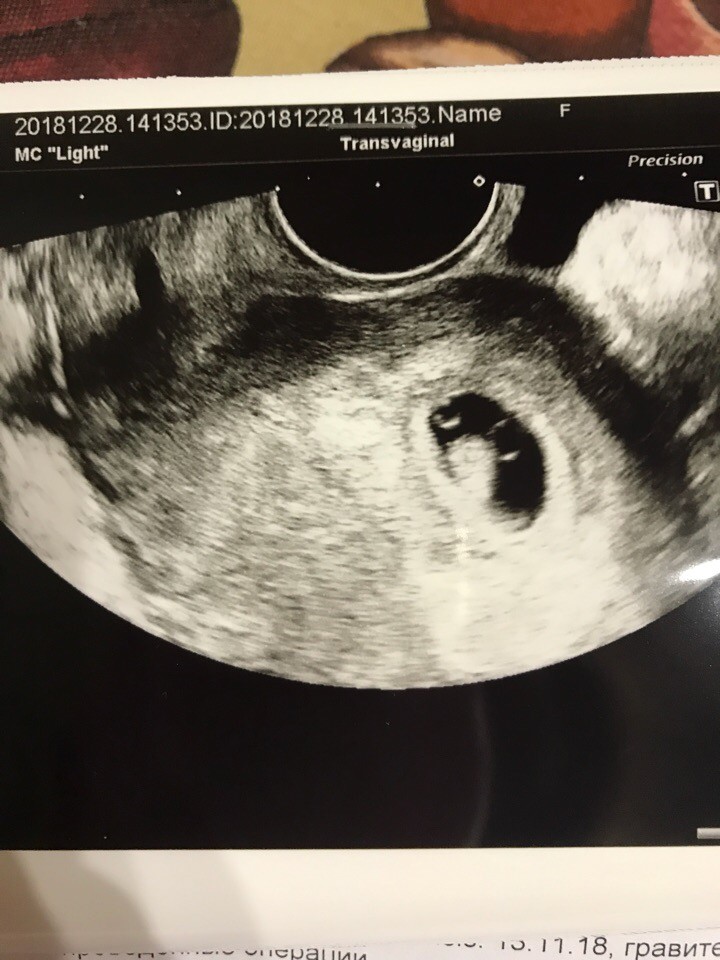 Фото узи при беременности 3 4 недели
