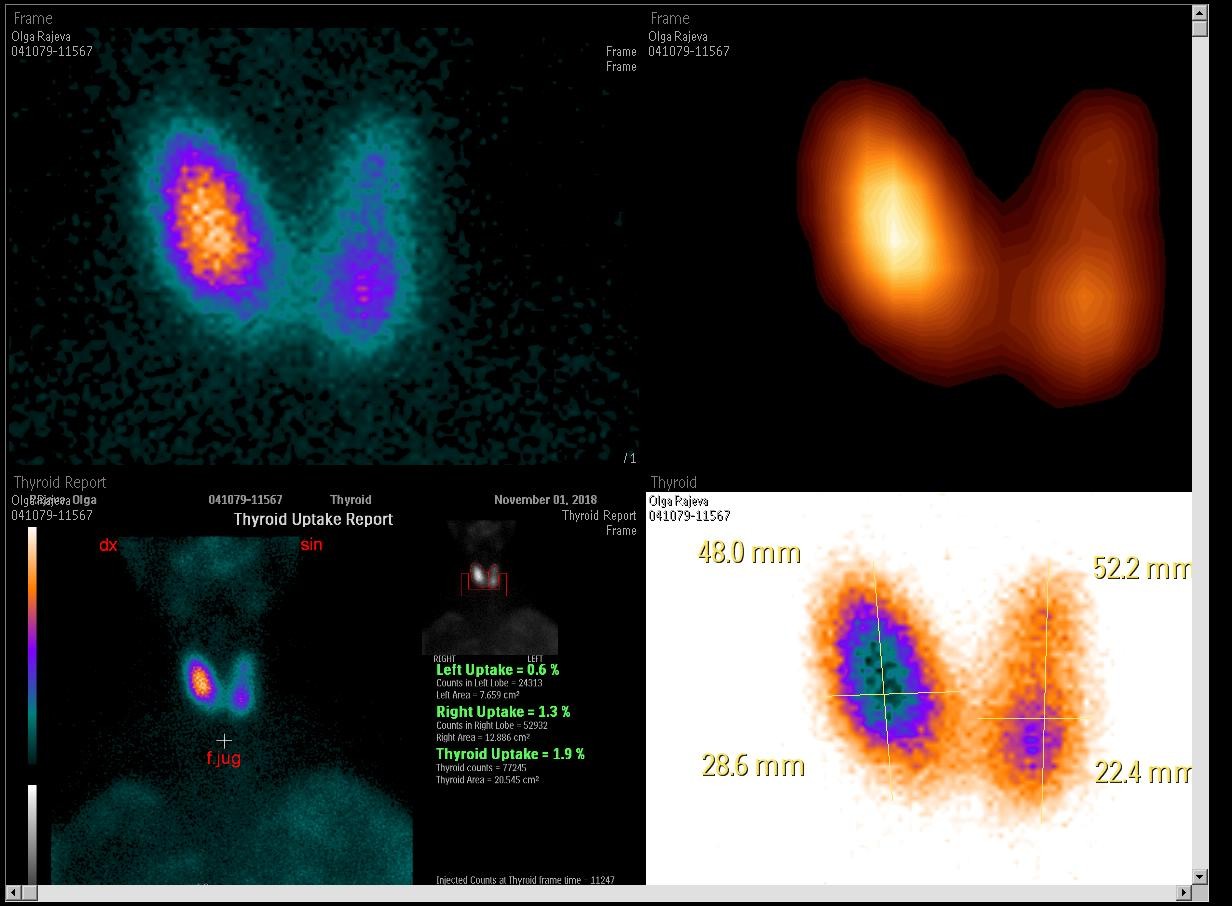 Сцинтиграфия щитовидной железы картинки