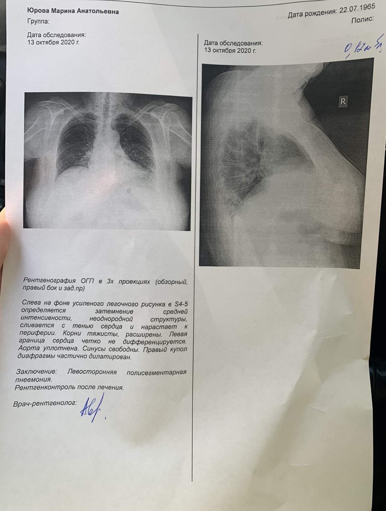 Рентген легких полисегментарная пневмония