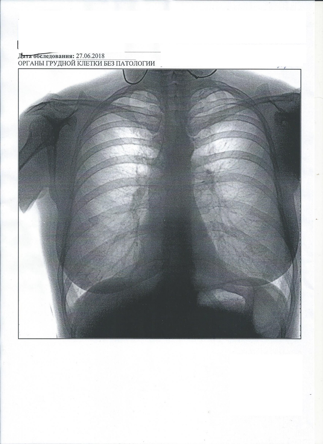 Флюорография какого. Флюорограмма органов грудной клетки. Флюорография органов грудной клетки. Органы грудной клетки без видимой патологии. Флюорография органов грудной полости.