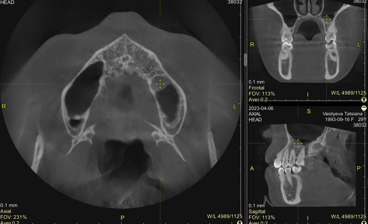 Утолщенная слизистая пазух. Снимки синусита на рентгене. Гайморит рентгеновский снимок.