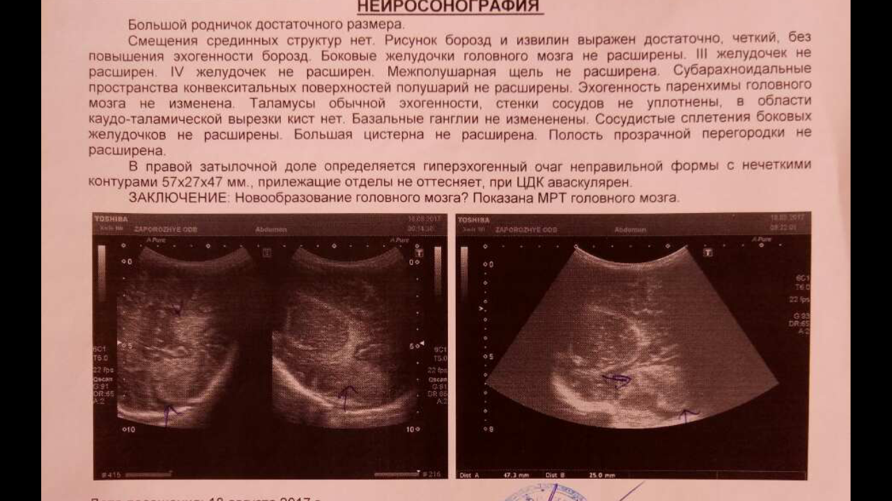 Расширенная полость. Расширение полости прозрачной перегородки головного мозга. Полость прозрачной перегородки головного мозга у новорожденных. Полость прозрачной перегородки головного мозга норма. Полость прозрачной перегородки норма у новорожденного.