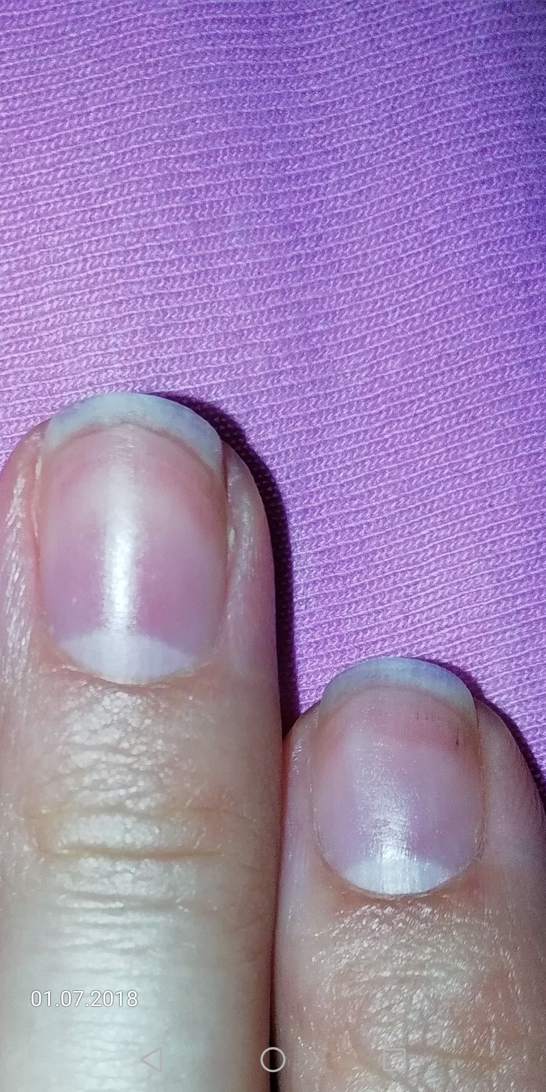 Полоски на ногтях причины вертикальные у женщин. Ониходистрофия, лейконихия. Лейконихия продольная. Ониходистрофия (дистрофия ногтей). Продольные полосы на ногтях.
