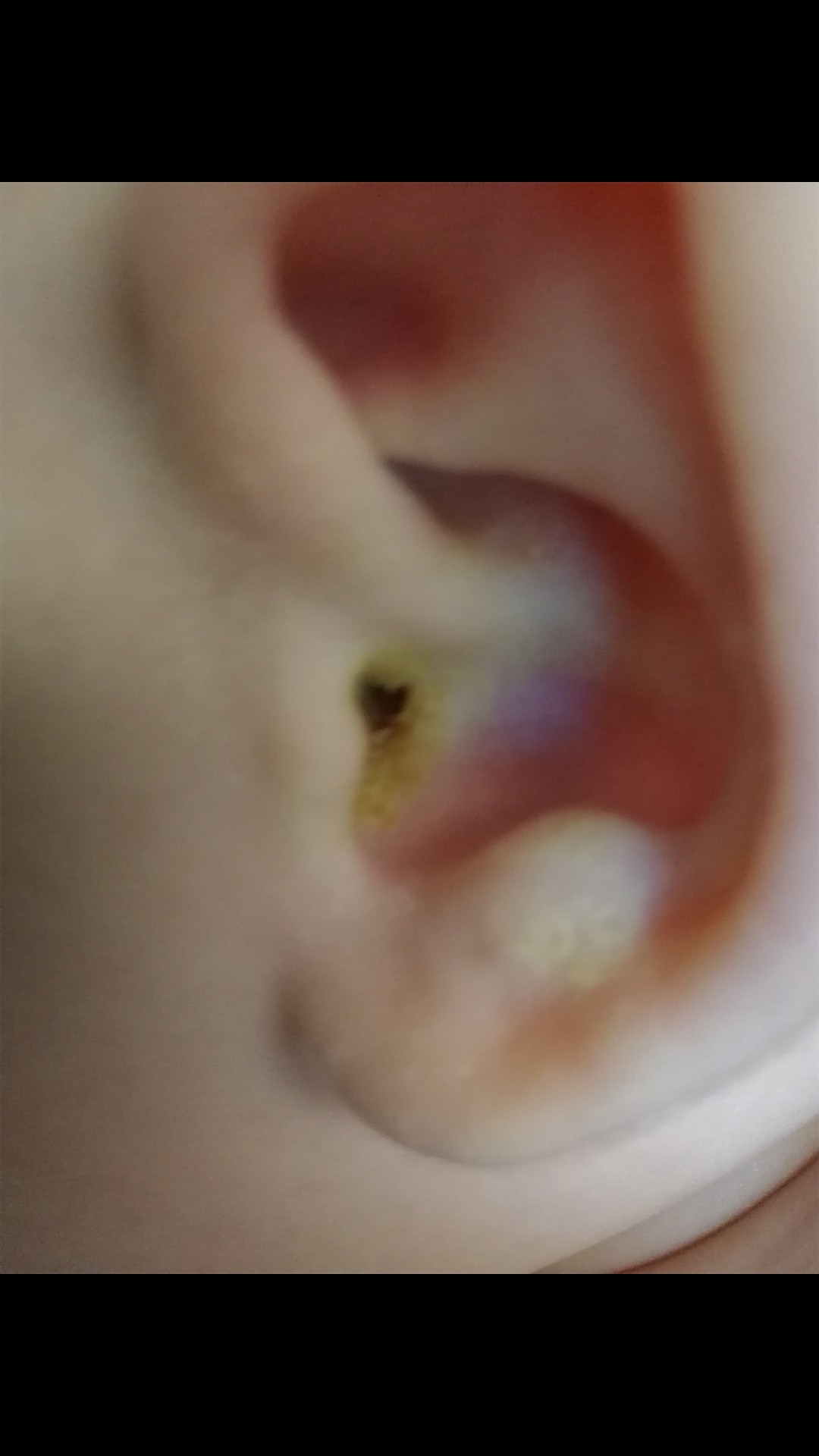 Серная пробка в ухе у ребенка фото