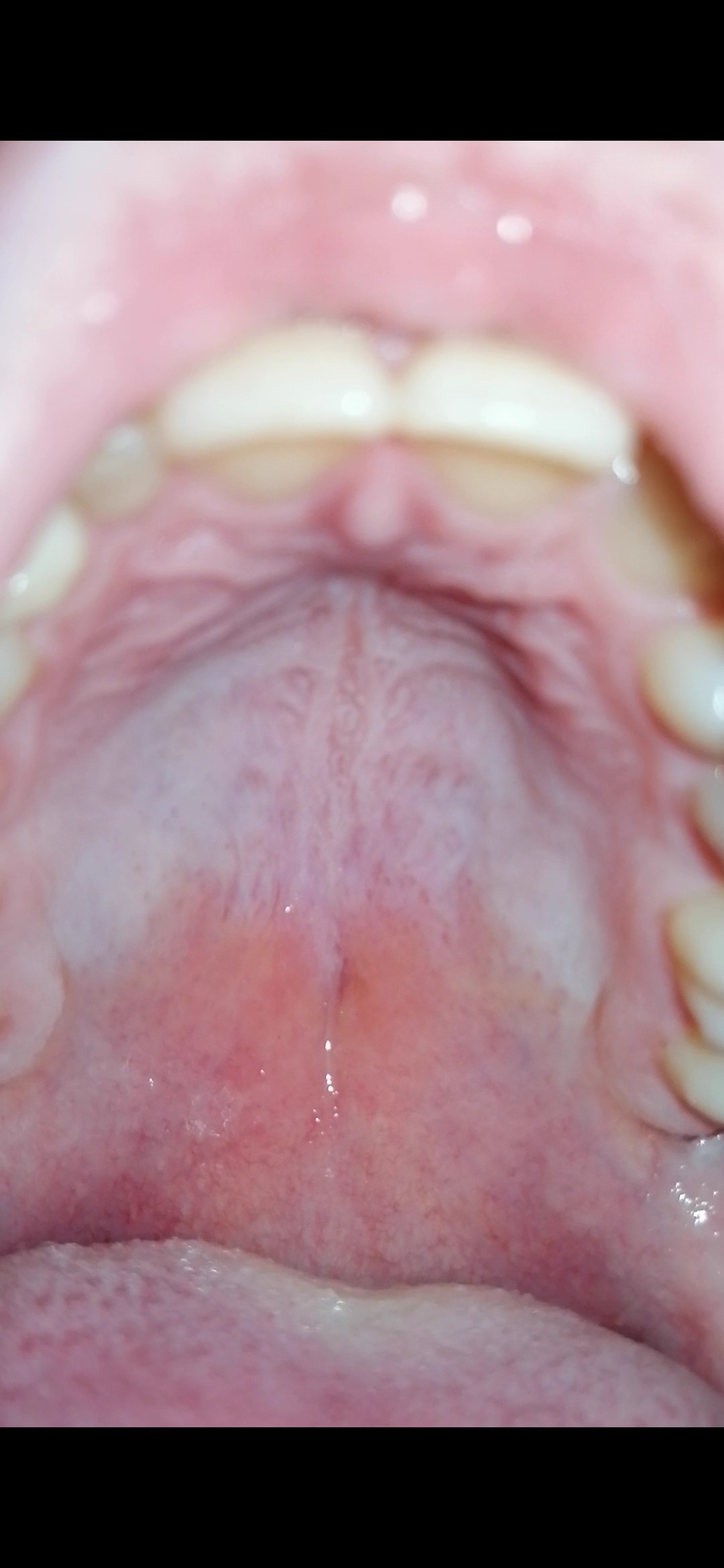 Кандидоз полости рта (молочница во рту)