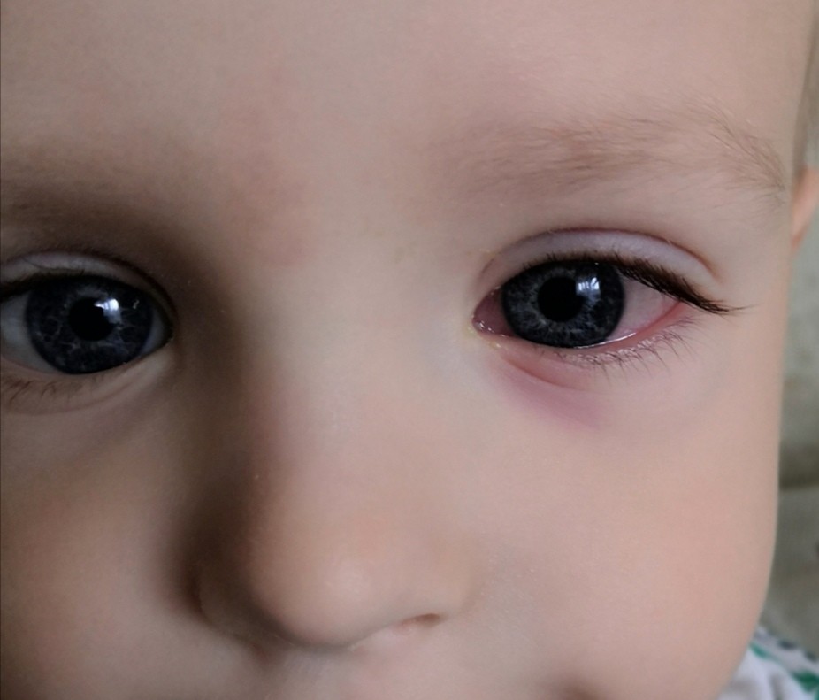 Глазки в 3 месяца. Глаза ребенка. Покраснение внутреннего века у ребенка.