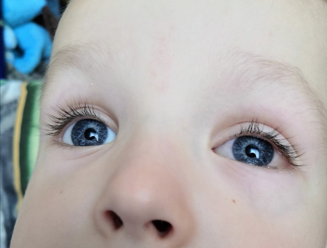 Белки глаз новорожденного. Опух белок глаза у ребенка. Беличьи глаза.