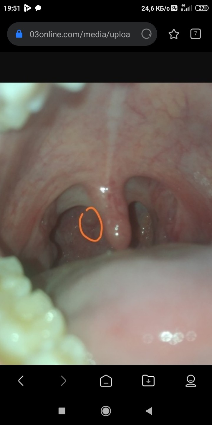 В горле белый гнойник фото