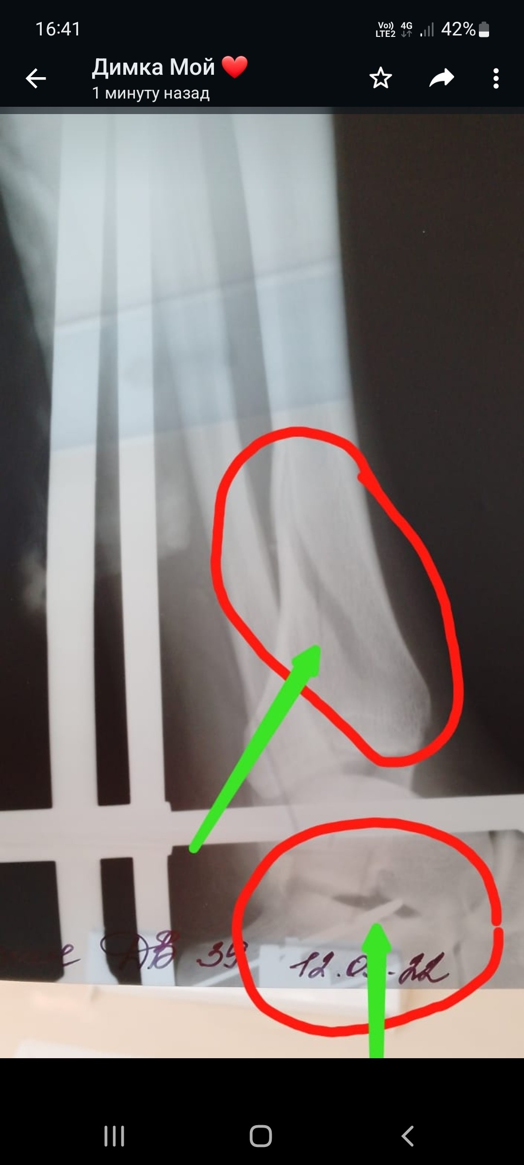 Перелом берцовой кости на ноге фото