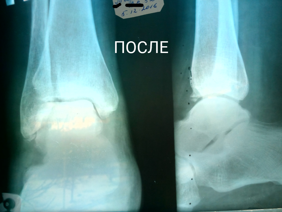 Срастание костей при переломе на рентгене. Сросшийся перелом лодыжки на рентгене. Перелом лодыжки рентген. Краевой перелом лодыжки.