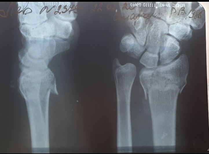 Перелом лучевой кости в типичном месте карта вызова смп