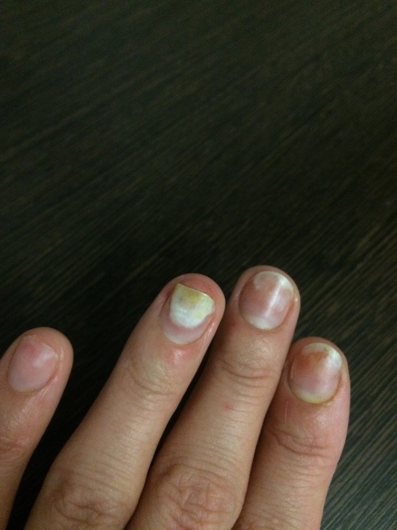 Болят ногти после снятия гель