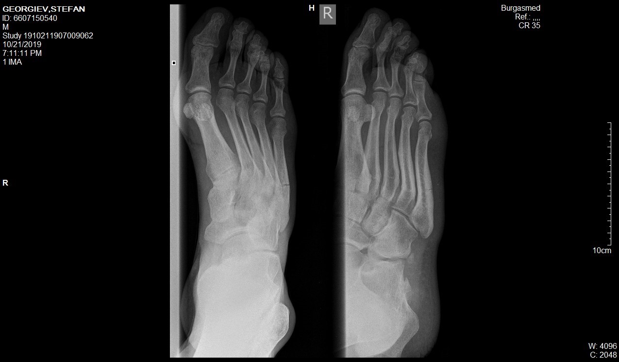 Перелом плюсневой кости мкб 10. Основание 5 плюсневой кости рентген. Перелом метаэпифиза плюсневой кости. Маршевый перелом 3 плюсневой кости.
