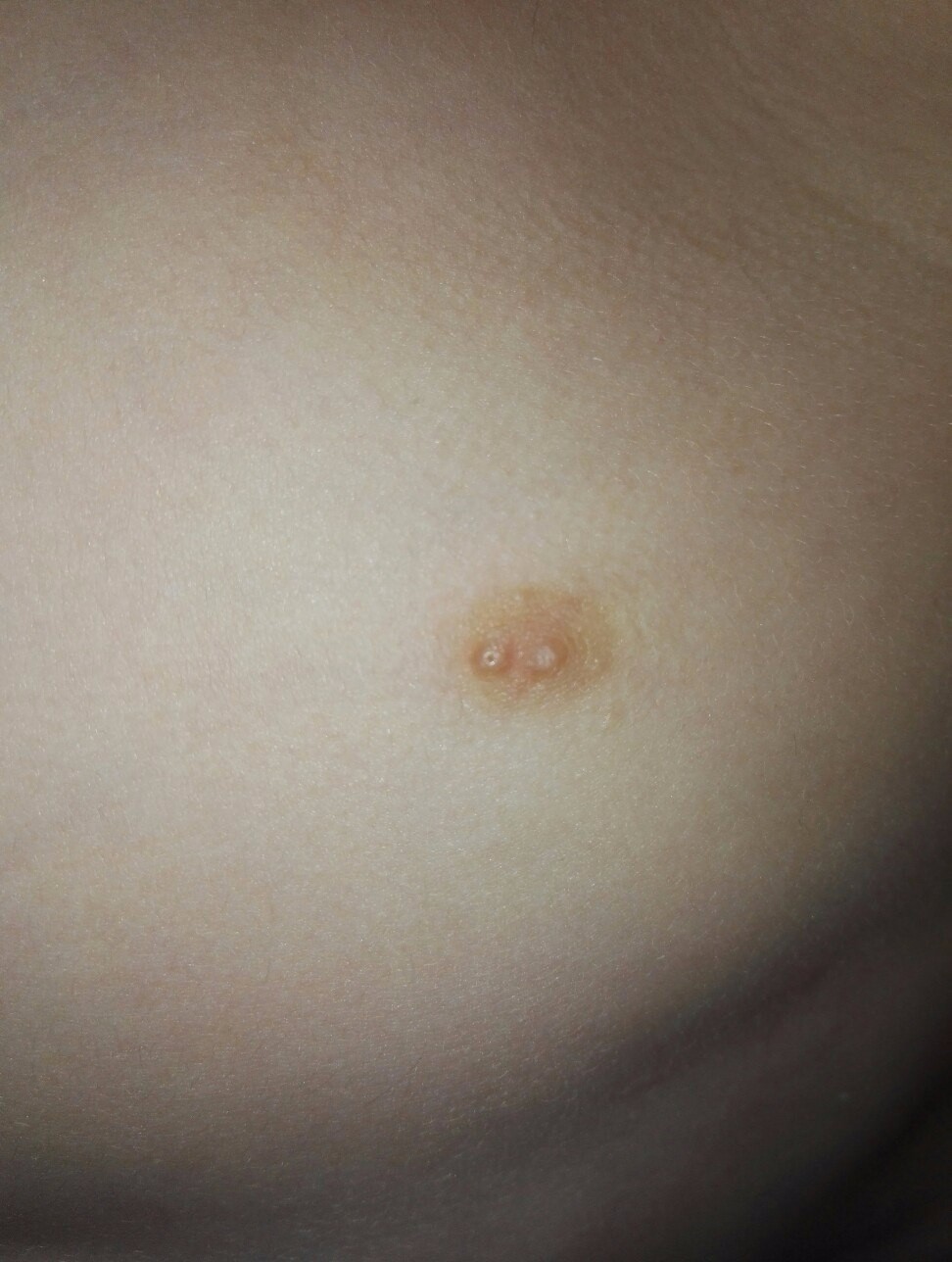 пупырышки на груди у женщин фото 114