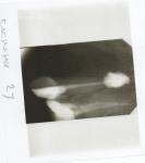 Отек щеки после лечения зуба фото 1