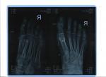 Перелом пальца на ноге фото 1