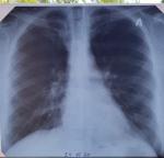 Рентген ОГК в 2-х проекциях, уточнение диагноза фото 1