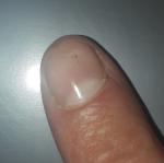 Черная полоса на ногте фото 1