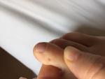 Пятно на ногте, гематома или нет, помогите разобраться, пож-та фото 1