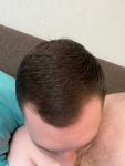 Выпадение волос у мужчины фото 2