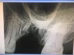 Перфорация гайморовой пазухи корнем зуба при удалении фото 1