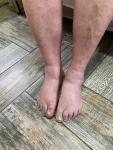 Болит большой палец на ноге, с грибковым ногтем фото 3